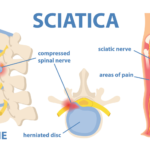 Qigong for relieve sciatica pain
