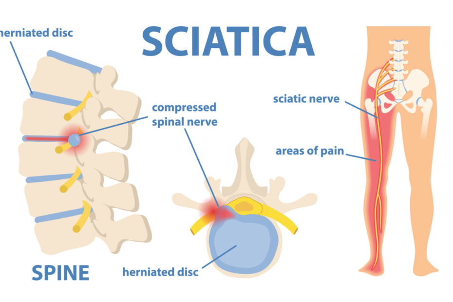 Qigong for relieve sciatica pain